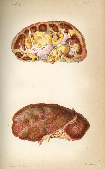 drawing of diseased kidney