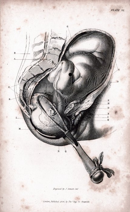 Drawing of the use of forceps to delive a baby